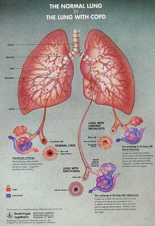 Copd Tripod